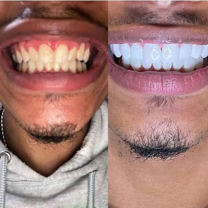 Cepillo sónico anti-manchas – Café, té y tabaco